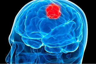 Linee guida per il trattamento di tumori cerebrali primitivi e metastatici degli adulti